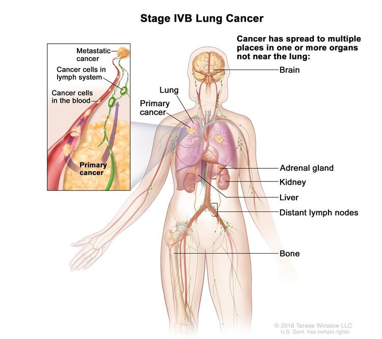 Ung thư phổi giai đoạn IVB. Ung thư đã lan đến nhiều nơi trong một hoặc nhiều cơ quan không gần phổi, chẳng hạn như não, tuyến thượng thận, thận, gan, các hạch bạch huyết xa hoặc xương.