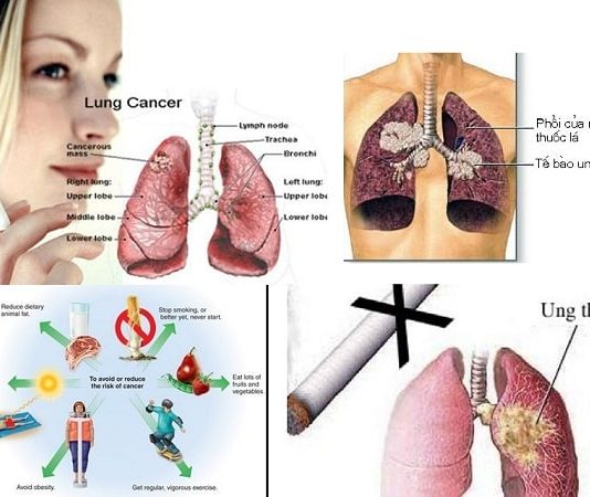 cac yeu to nguy co gay ung thu phoi la gi (2)