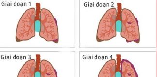 giai doan ung thu phoi bao gom giai doan ung thu phoi te bao nho va khong phai te bao nho (1)