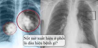 not hach o phoi la gi, not hach duoc dieu tri nhu the nao - ung thu phoi (1)