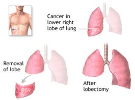 phau thuat cat thuy phoi la gì (3)