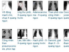 x quang nguc la gi