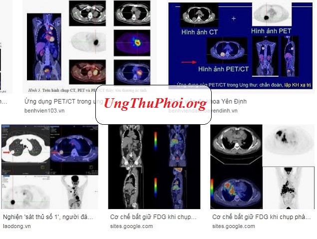 Chụp Positron quan sát quá trình trao đổi chất trong cơ thể như là một trợ giúp chẩn đoán bệnh chup positron cat lop pet scan la gi (2)