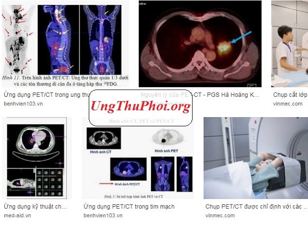 Chụp cắt lớp phát xạ Positron ( PET ) là một kỹ thuật hình ảnh chức năng y học hạt nhân chup positron cat lop pet scan la gi (2)