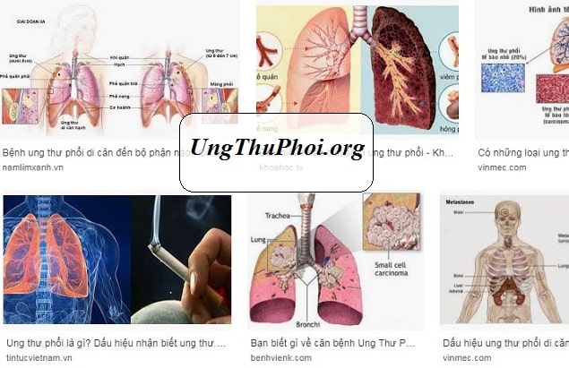 Hút thuốc, đặc biệt là thuốc lá điếu, cho đến nay là tác nhân chính gây ra ung thư phổi hut thuoc dac biet la thuoc la dieu cho den nay la tac nhan chinh gay ra ung thu phoi