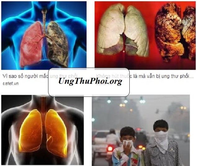 o nhiem khong khi o ha noi bui min la tac nhan gay ung thu phoi (1)