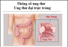 thong so ung thu - ung thu dai truc trang