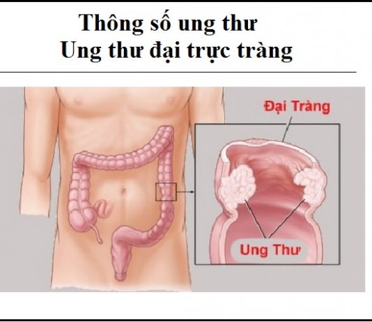 thong so ung thu - ung thu dai truc trang