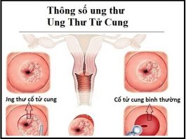 thong so ung thu - ung thu tu cung