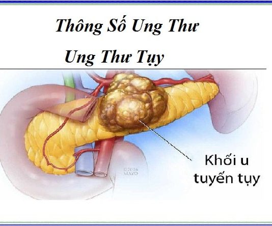 thong so ung thu - ung thu tuy