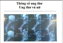 thong so ung thu - ung thu vu o nu
