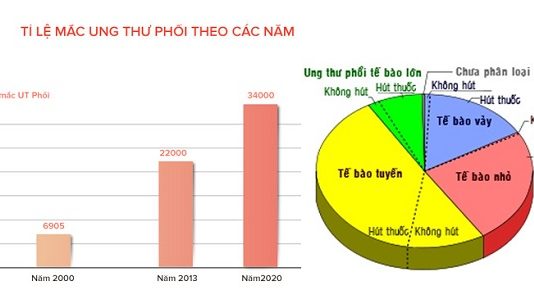 ty le ung thu phoi theo chung toc va dan toc