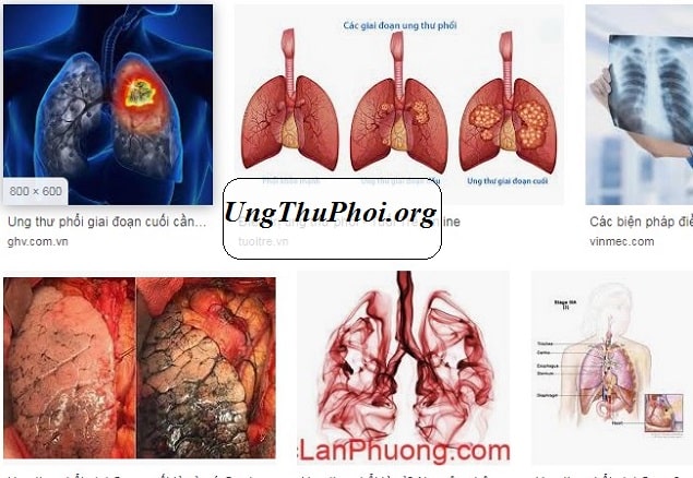 Ung thư phổi xuất hiện khối u ác tính qua sự tăng sinh tế bào không thể kiểm soát trong mô phổi ung thu phoi la can benh xuat hien khoi u ac tinh duoc mo ta qua su tang sinh te bao khong the kiem soat trong cac mo phoi