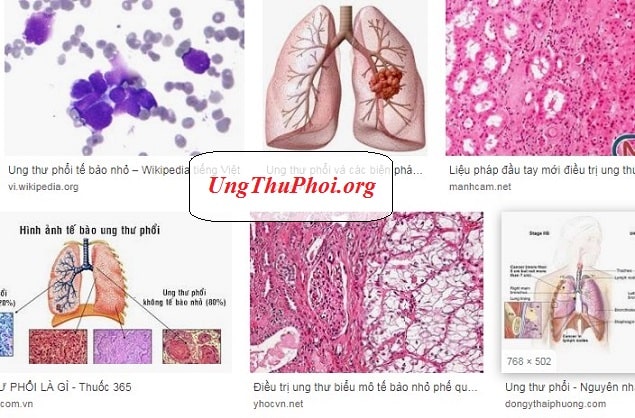 Ung thư phổi tế bào nhỏ thường không có triệu chứng, có nghĩa là bệnh không gây ra triệu chứng ung thu phoi te bao nho la gi Nguyen nhan trieu chung benh ra sao (1)