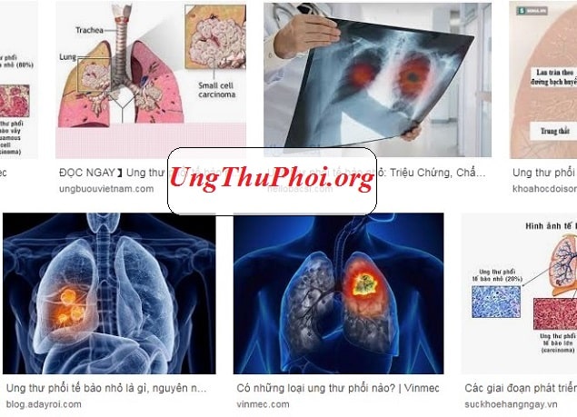 Các triệu chứng thường không xuất hiện cho đến khi ung thư đã tiến triển đến giai đoạn nặng hơn ung thu phoi te bao nho la gi Nguyen nhan trieu chung benh ra sao (3)