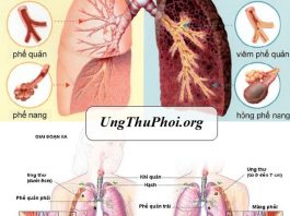 ung thu phoi va phe quan - tong quan