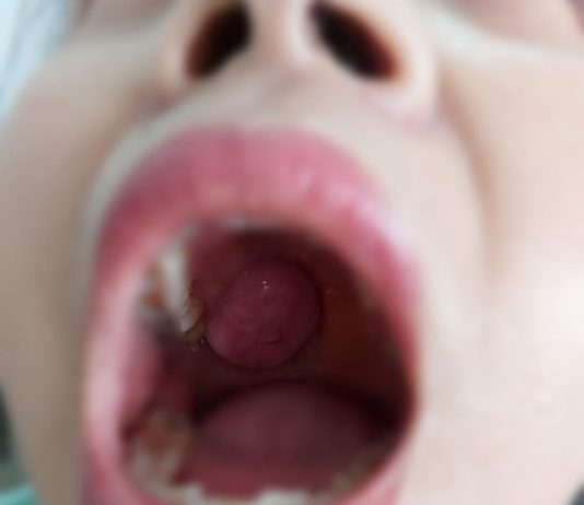 Sau 3 năm, khối u trong khoang miệng hóa ung thư ăn mòn xương - 1