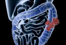 Ung thư ruột kết vì lạm dụng kháng sinh - 1