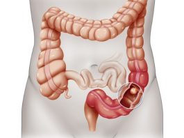 Xác định loại vi khuẩn làm tăng nguy cơ mắc ung thư lên 42 lần - 1