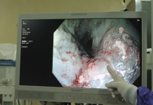 Nhờ hóc thịt ngan, người đàn ông phát hiện kịp thời ung thư thực quản - 1