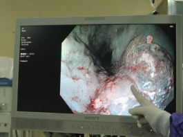 Nhờ hóc thịt ngan, người đàn ông phát hiện kịp thời ung thư thực quản - 1