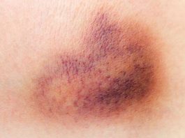 9 dấu hiệu ung thư máu dễ bị bỏ qua - 1