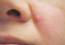 Ba dấu hiệu dễ bỏ qua của ung thư da Ba dấu hiệu dễ bỏ qua của ung thư da - 1