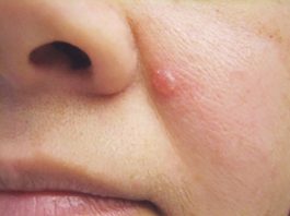 Ba dấu hiệu dễ bỏ qua của ung thư da - 1