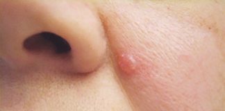 Ba dấu hiệu dễ bỏ qua của ung thư da - 1