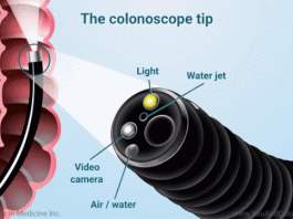 Bác sĩ diệt mầm mống ung thư đại tràng bằng kỹ thuật nội soi như thế nào? - 1
