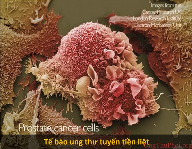Giải mã cách tế bào ung thư tuyến tiền liệt "tái sinh" sau khi điều trị 2