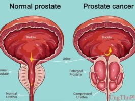 Giải mã cách tế bào ung thư tuyến tiền liệt "tái sinh" sau khi điều trị