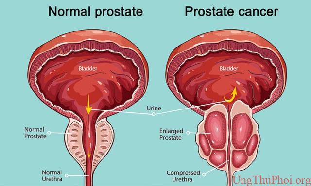 Giải mã cách tế bào ung thư tuyến tiền liệt "tái sinh" sau khi điều trị 1