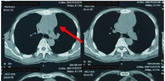 Đi khám vì đau ngực, khó thở, người đàn ông phát hiện mắc thể ung thư hiếm - 1