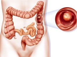 Khi nào nên bắt đầu khám sàng lọc ung thư đại trực tràng? - 1
