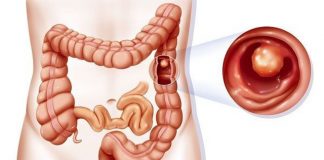 Khi nào nên bắt đầu khám sàng lọc ung thư đại trực tràng? - 1