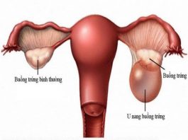 7 biểu hiện u nang buồng trứng - 1
