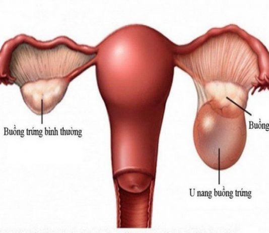 7 biểu hiện u nang buồng trứng - 1