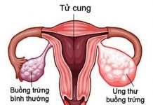 Liệu pháp tiêu chuẩn mới trong điều trị ung thư buồng trứng tái phát - 1