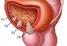 Liệu pháp kéo dài cuộc sống bệnh nhân ung thư bàng quang Liệu pháp kéo dài cuộc sống bệnh nhân ung thư bàng quang - 1