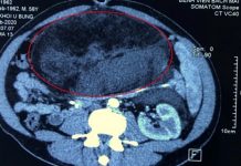 Đau tức bụng vào viện, người đàn ông phát hiện khối u nặng 6kg Đau tức bụng vào viện, người đàn ông phát hiện khối u nặng 6kg - 1