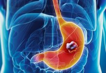 Làm gì để phát hiện sớm ung thư dạ dày? Làm gì để phát hiện sớm ung thư dạ dày? - 1