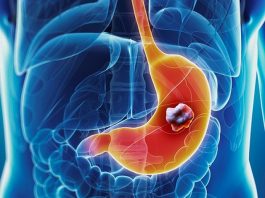 Làm gì để phát hiện sớm ung thư dạ dày? - 1