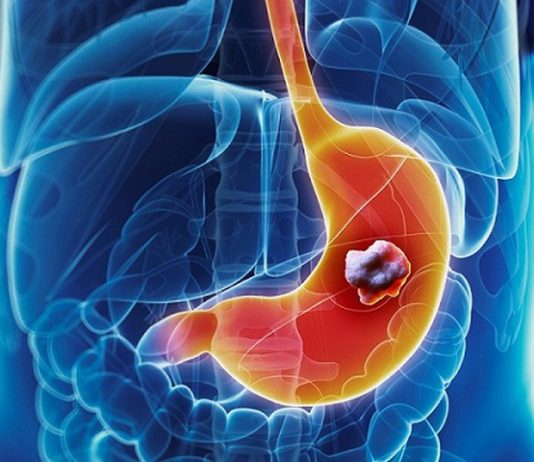 Làm gì để phát hiện sớm ung thư dạ dày? - 1