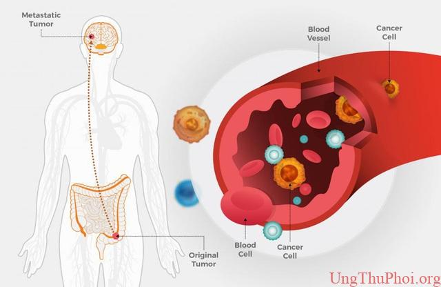 Lần đầu phát hiện gen di truyền “điều khiển” quá trình di căn của ung thư - 3 Lần đầu phát hiện gen di truyền “điều khiển” quá trình di căn của ung thư - 3