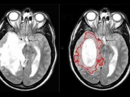 Phát hiện mới: Loại ung thư kháng được hóa, xạ trị lại sợ… thuốc sốt rét - 1