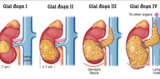 Mách bạn nhận biết sớm ung thư thận - 1