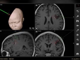 U não ở trẻ em: 70% là ác tính, dấu hiệu nào cảnh báo nguy cơ? - 1