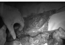 Đoạn chậu toàn phần cứu bệnh nhân ung thư cổ tử cung tái phát Đoạn chậu toàn phần cứu bệnh nhân ung thư cổ tử cung tái phát - 1