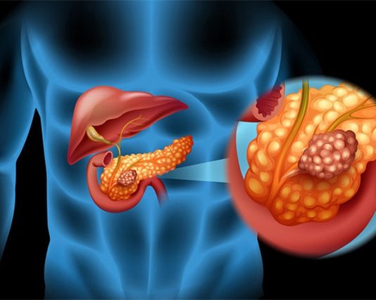 Ung thư tụy, căn bệnh nguy hiểm, rất dễ bị bỏ qua dấu hiệu sớm - 1